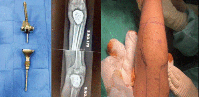 جناح اسپتال میں کینسر کے مریض کا پہلا مصنوعی گھٹنے کا کامیاب آپریشن
